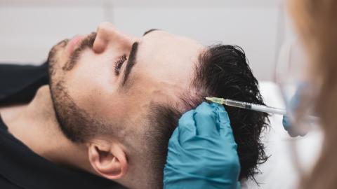 implante clinica capilar