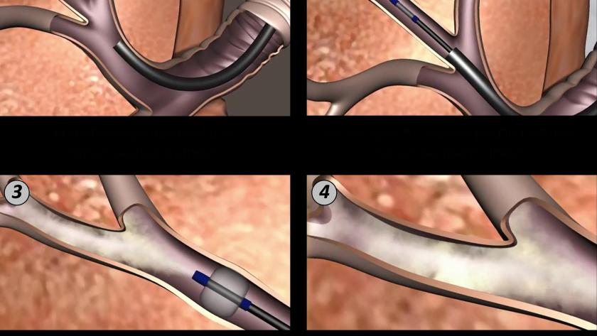 Técnica pionera en España para el enfisema pulmonar severo