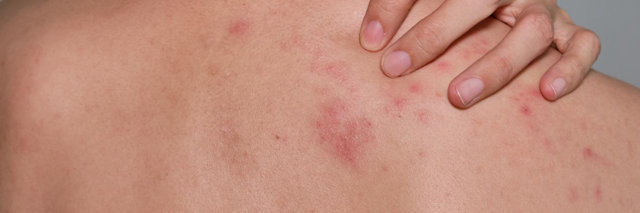 Espalda con sarpullido y mano en el hombre