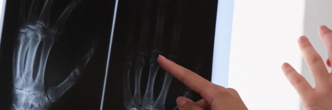 Radiografía de mano con artritis reumatoide