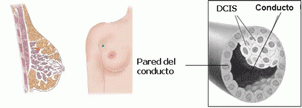 cáncer de mama. Estadío 0