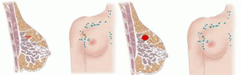 cáncer de mama. Estadío II