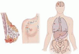 cáncer de mama. Estadío IV