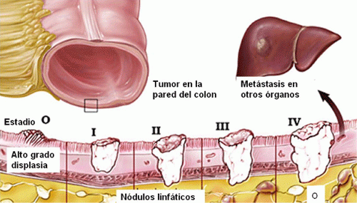 Estadíos cáncer colorrectal