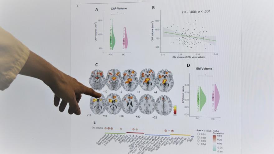 El grupo de enfermedades neurológicas del Clínico San Carlos ha publicado numerosos artículos sobre covid persistente