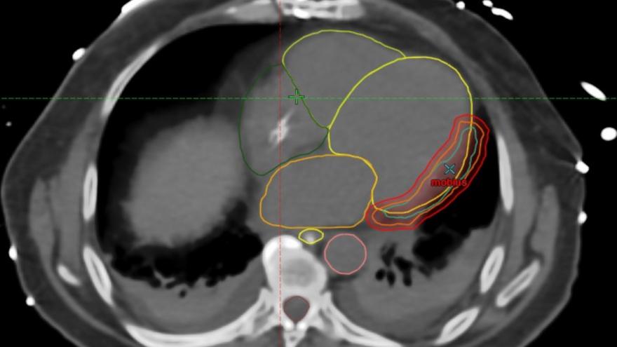 IMAGEN TORMENTA VENTRICULAR 2