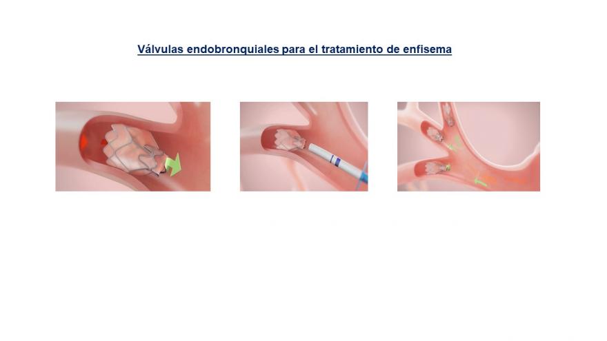 Válvulas endobronquiales