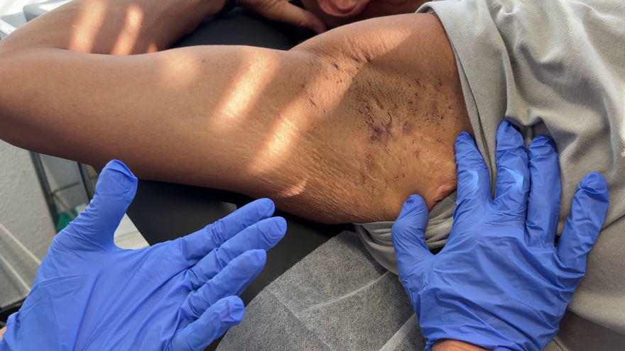 Hidradenitis supurativa Paciente del Hospital Universitario Severo Ochoa afectado de hidradenitis supurativa en la consulta de Dermatología