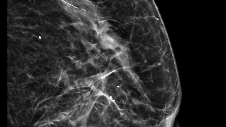 Las semillas se colocan junto al tumor de forma preoperatoria Una "semilla" colocada en una mama