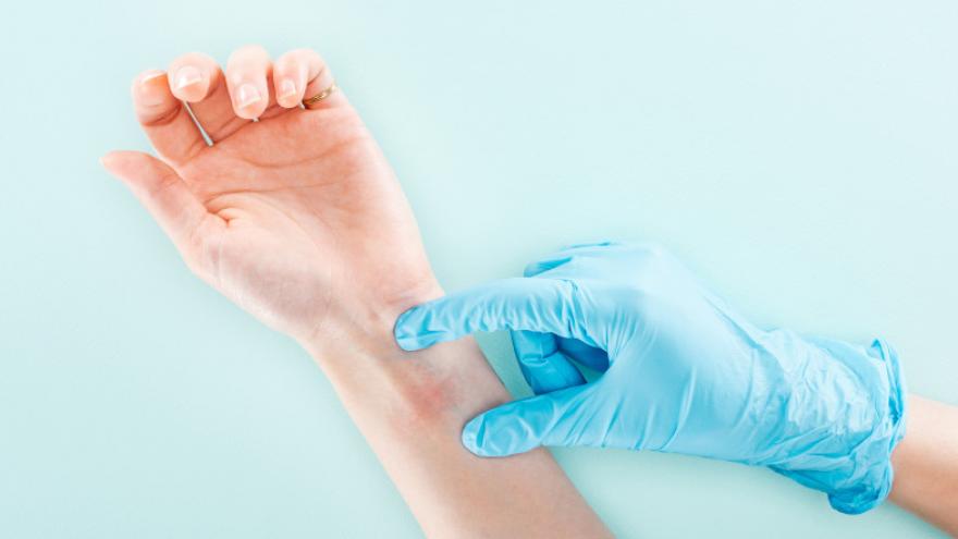 foto Día Mundial de la Alergia