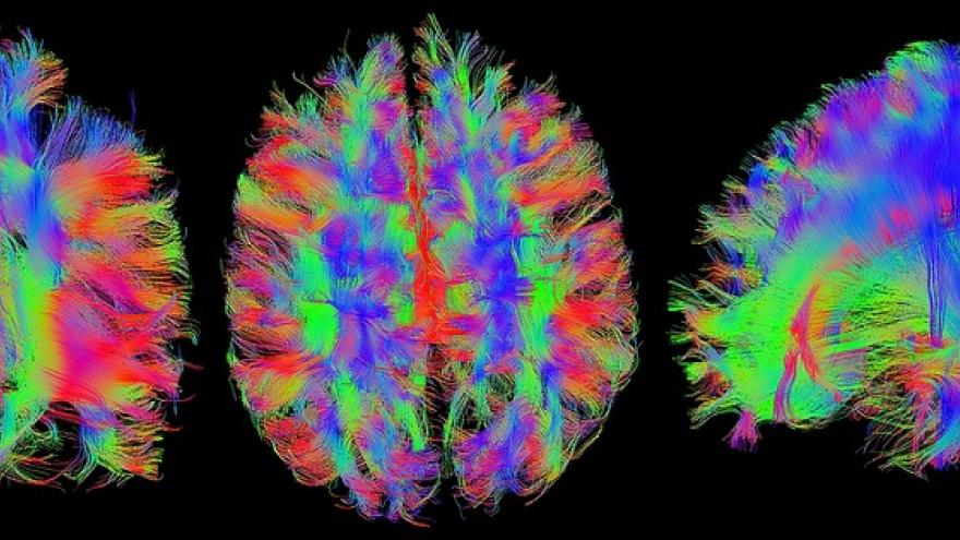 Imagen resonancia cerebro