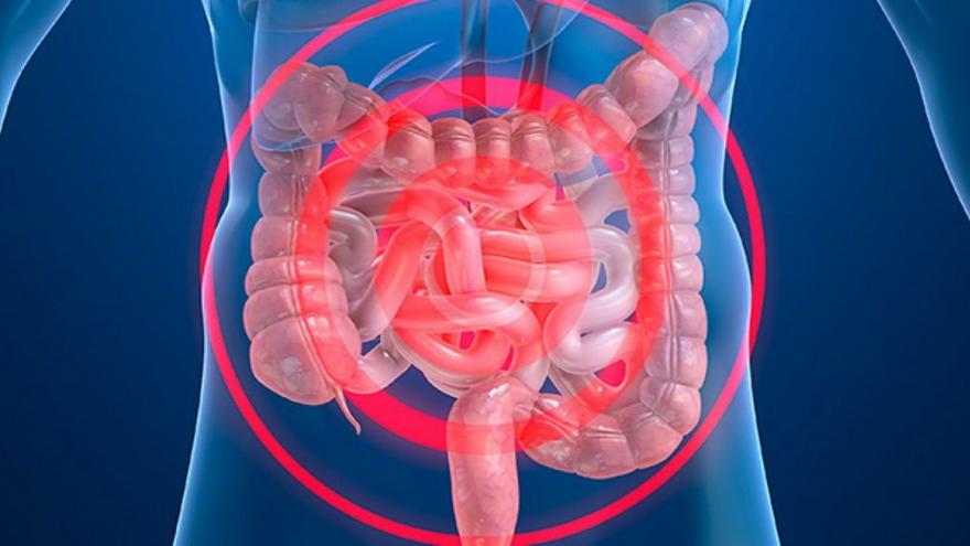 Enfermedad inflamatoria intestinal