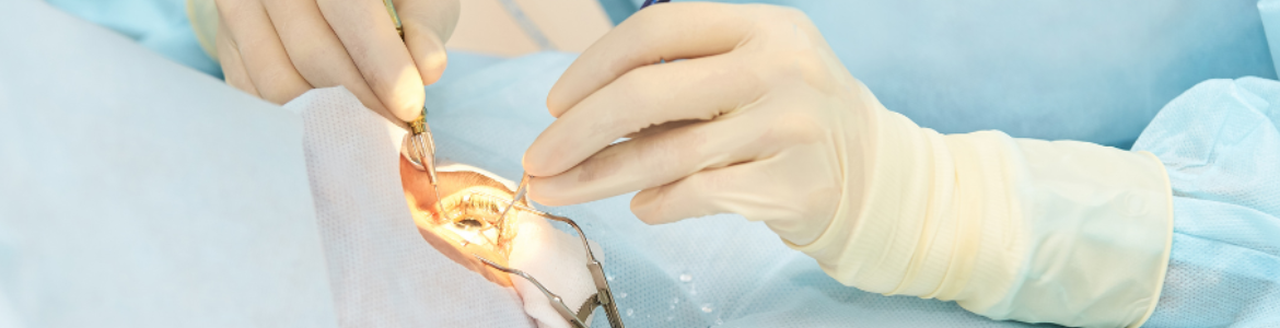 Intervención en ojo. primer plano de manos con guantes blancos interviniendo en un ojo en quirófano