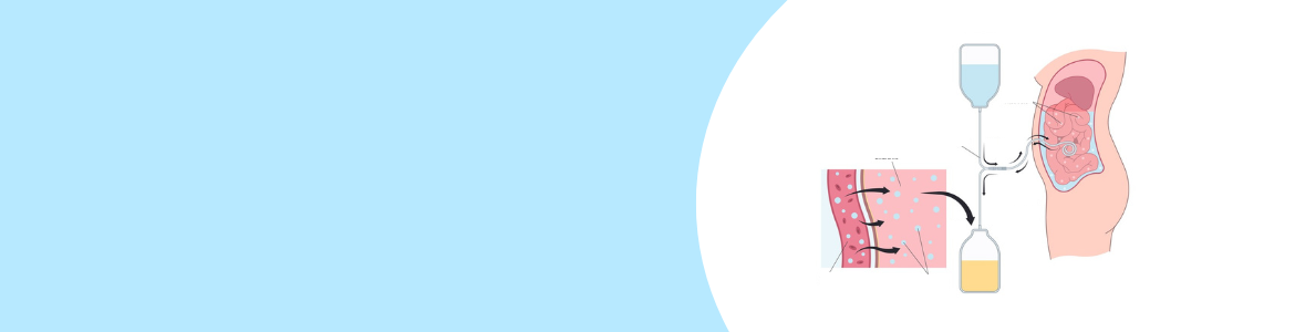 Gráfico de diálisis con dibujo de un torso y un recipiente con líquido azul y otro amarillo con un tubo que entra al cuerpo y otro que salecuerpo