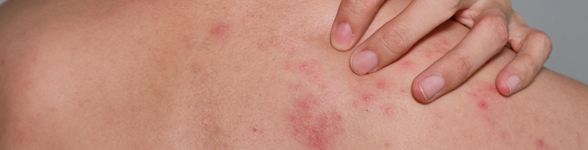 Espalda con sarpullido y mano en el hombre