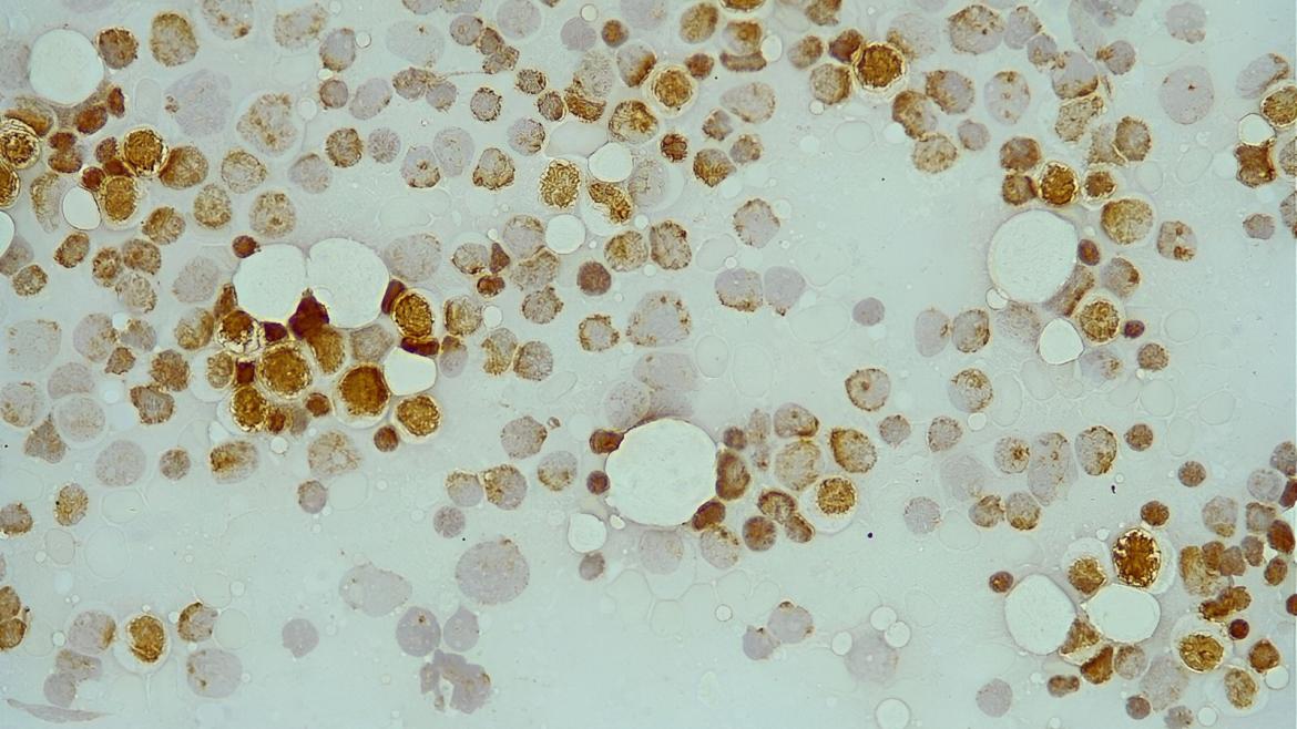 Células cancerosas, en color marrón, en una leucemia mieloide aguda resistente a fármaco Citarabanina Imagen de células de distintos colores con las de color marrón más destacadas