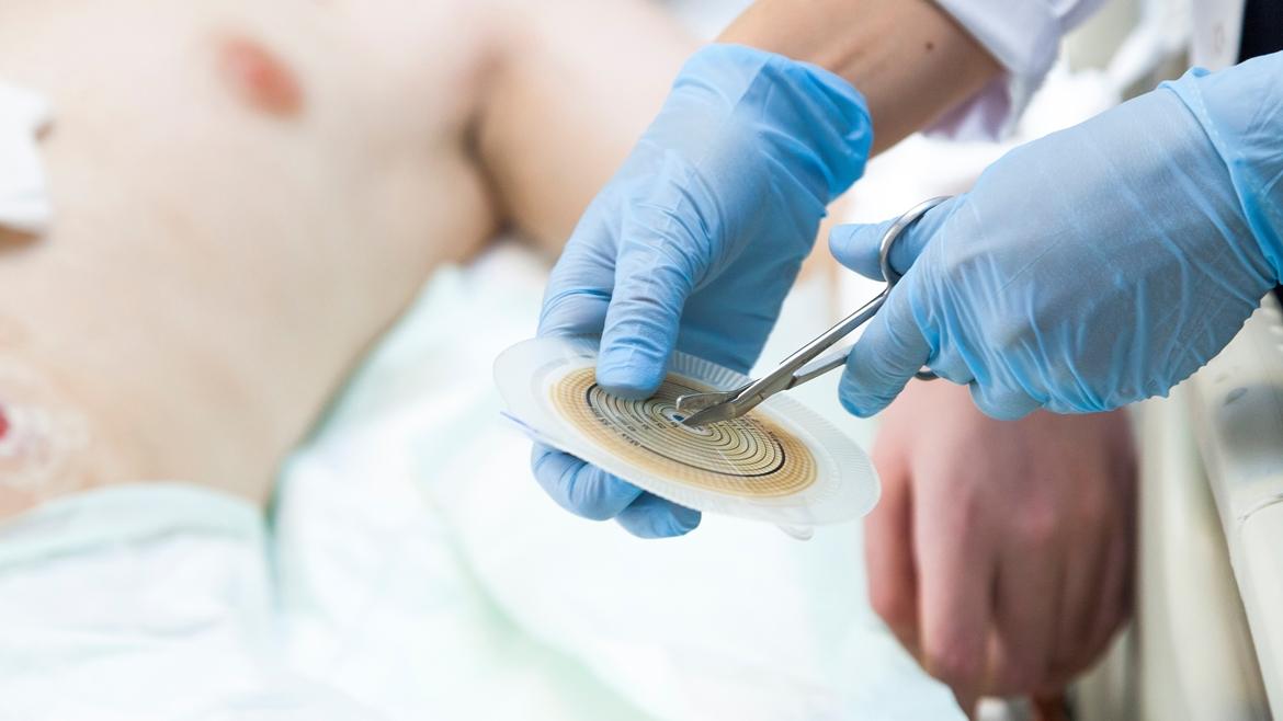 Imagen de un paciente ostomizado