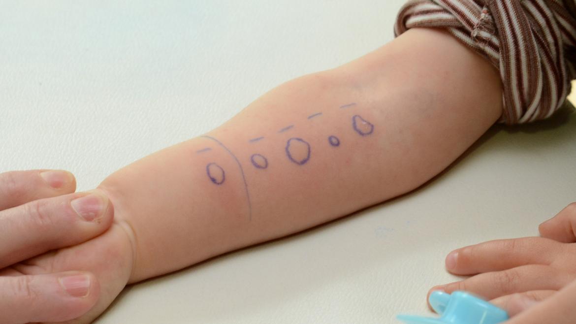 Brazo en el que se realiza pruebas de alergia