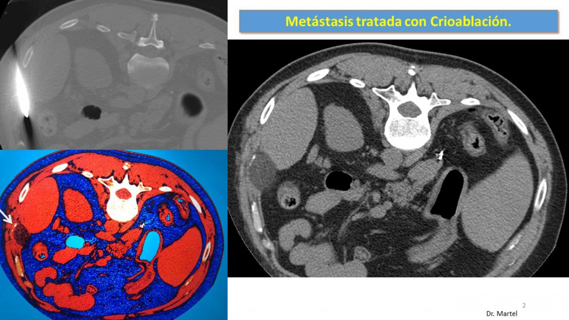 Imagenes de una metástasis tratado con crioablación