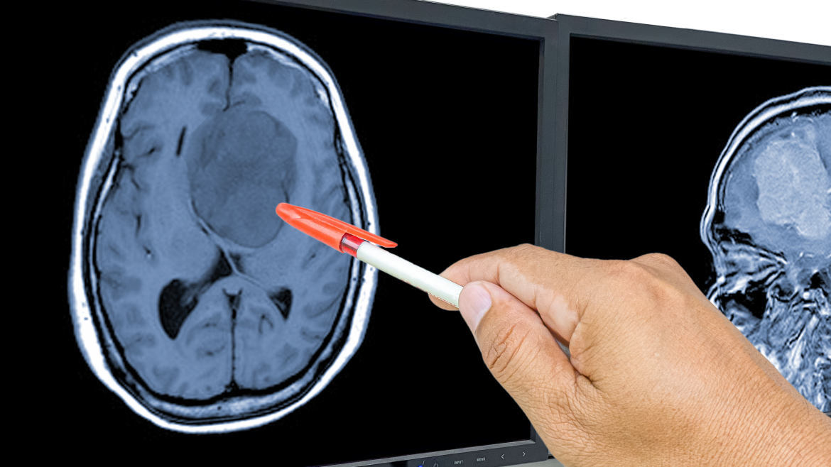 Glioblastoma imagen de escáner de cerebro con mancha y mano con boli de médico que señala