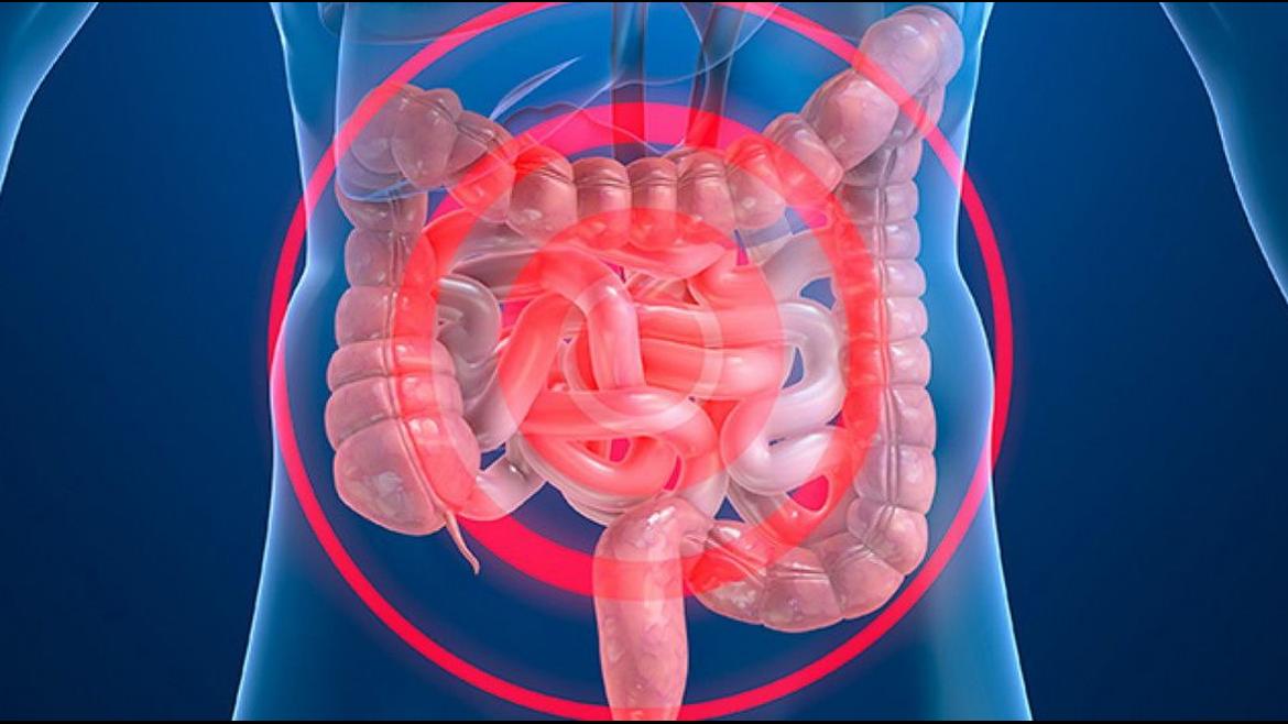 Enfermedad inflamatoria intestinal