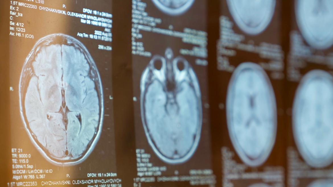 Imagen resonancia magnética cerebro