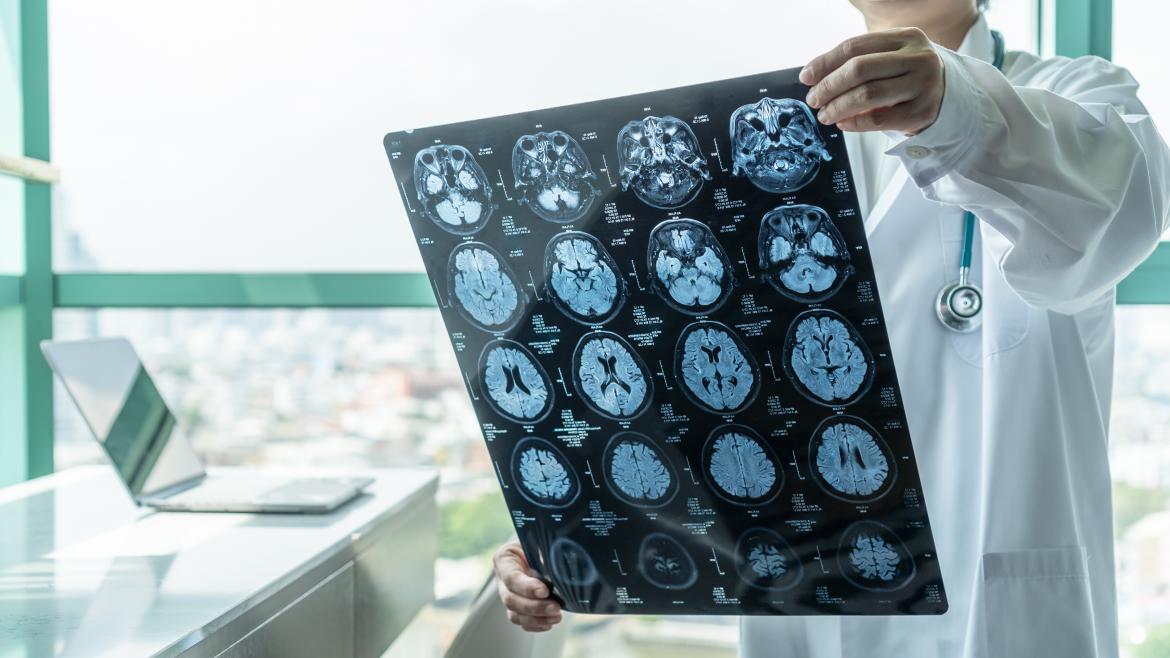 Medico observando una resonancia magnética cerebral